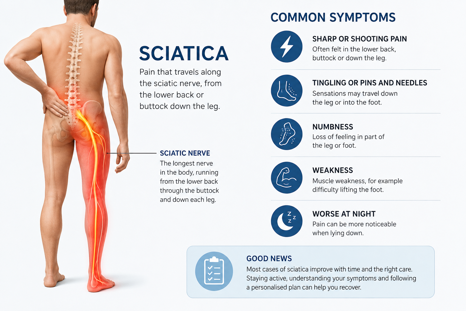 Illustration showing a common pattern of sciatica symptoms travelling from the lower back into one leg