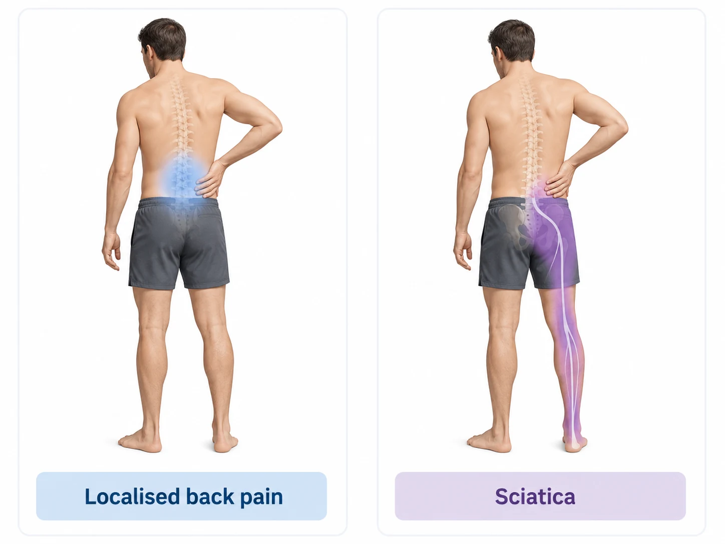 Comparison showing localised lower-back pain and sciatica symptoms travelling from the lower back into one leg